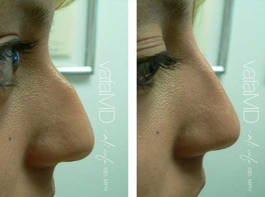 nose reshaping with fillers midtown manhattan